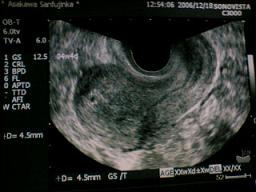 胎嚢 5w0d 5週2日の胎嚢10mm、流産の可能性を指摘されました